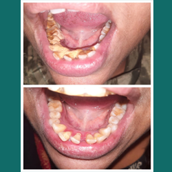 Why Professional Teeth Cleaning Is Important for Healthy Teeth