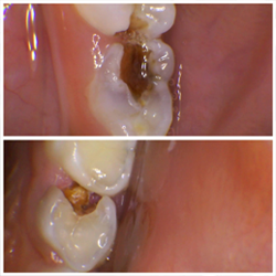 Tips to Prevent Cavities